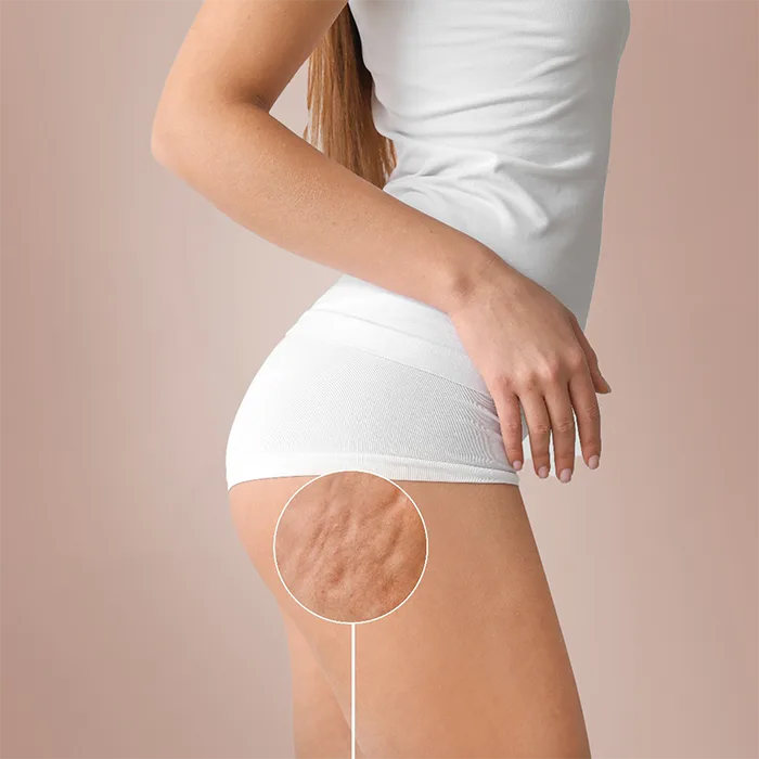 Cellulite